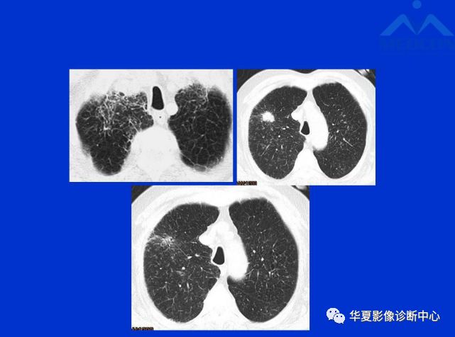 肺间质纤维化合并肺癌的ct诊断