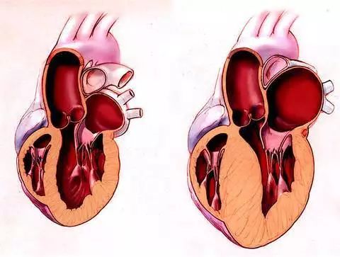 如左心室肥厚,心绞痛,心肌梗死和心力衰竭;心脏因克服全身小动脉硬化