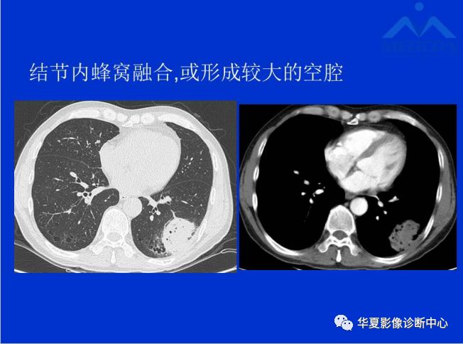 肺间质纤维化合并肺癌的ct诊断