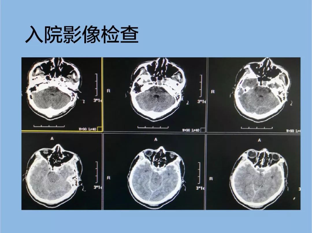 急性高颅压围手术期管理丨 颅脑创伤-神经重症病例周刊(73期)