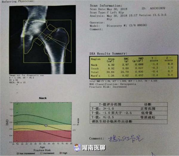 58岁大妈背部疼痛进医院,医生说,这两项骨密度检查不