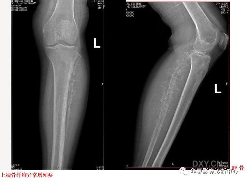 【推荐收藏】腓骨头及腓骨上端骨肿瘤(图文并茂)