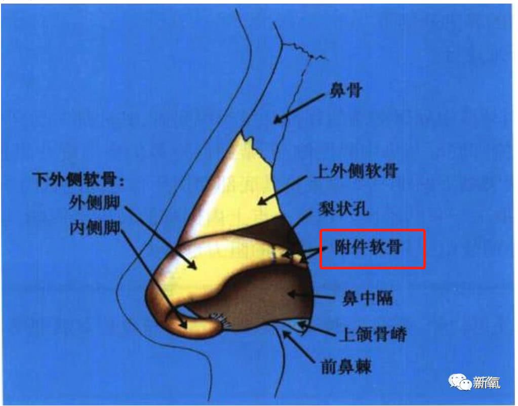 还有一种鹰钩鼻是因为鼻翼软骨的外侧脚复合体软骨跟梨状孔的结合位置