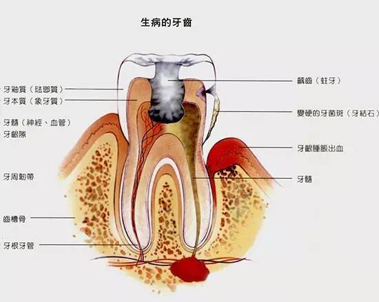 一旦出现牙髓炎应该怎么进行治疗呢