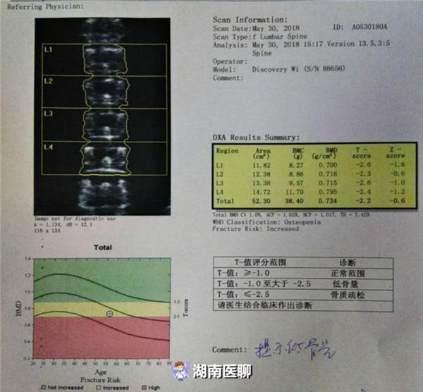 58岁大妈背部疼痛进医院医生说这两项骨密度检查不能少