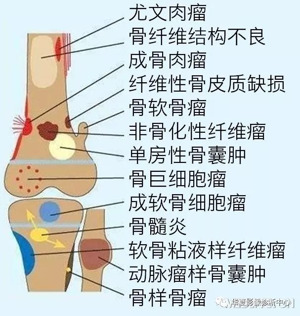 【推荐收藏】腓骨头及腓骨上端骨肿瘤(图文并茂)