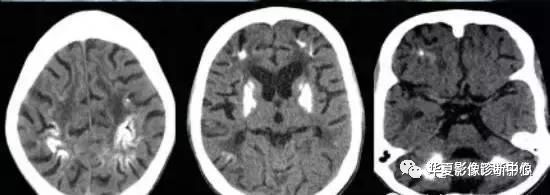 ct:双侧基底节区及其他部分钙化,颅骨和脑膜增厚,脑室和脑沟扩大,脑白