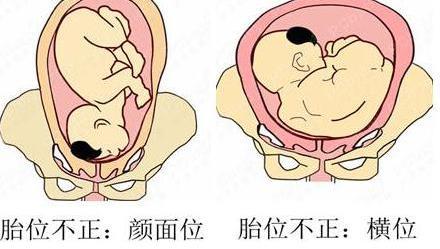 胎儿横位可以入盆吗?横位入盆有什么缺点