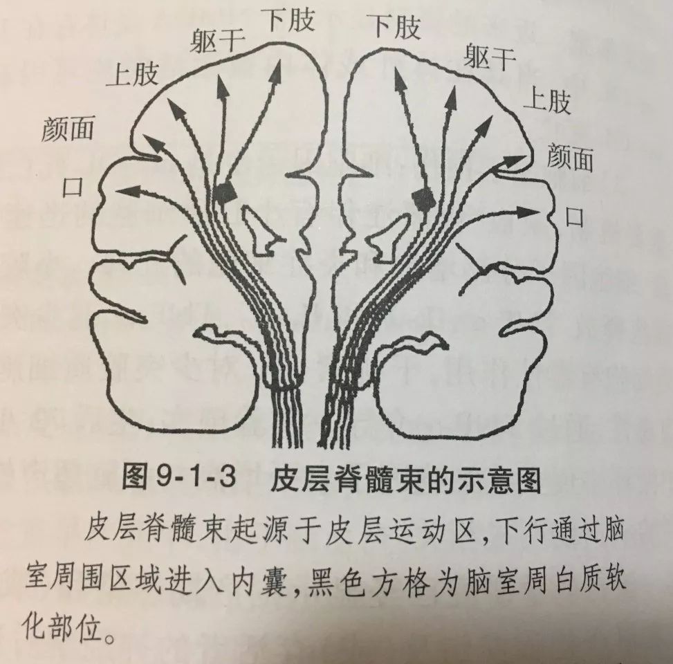 认识早产儿疾病系列科普脑室旁白质软化