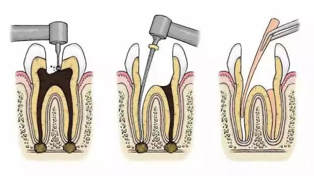 什么是牙齿打桩?什么是根管治疗?