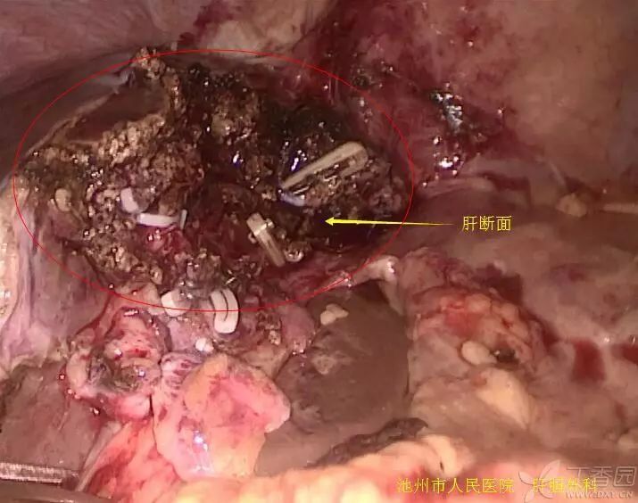 图解腹腔镜下左肝外叶切除术