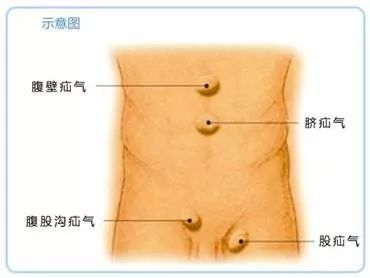 提醒| 宝宝腹股沟鼓起了个肉包是怎么回事?家长千万不