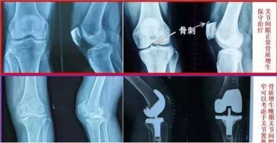 图4膝关节骨质增生x片
