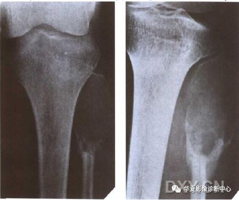 【推荐收藏】腓骨头及腓骨上端骨肿瘤(图文并茂)