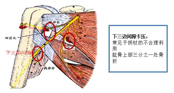 健康 正文  需要重点关注的三个狭窄部位:前中斜角肌间隙,锁骨和胸壁