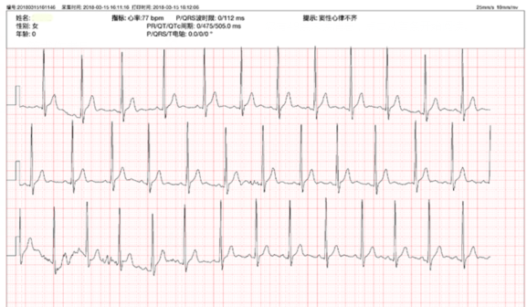 特别是当心电图报告上,清清楚楚的写着:窦性心律不齐时,几乎会吓坏一