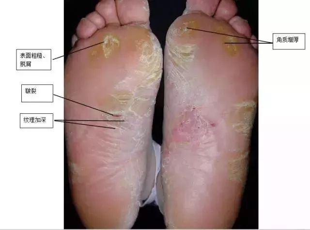 1 ,湿热脚气证:主要症状表现有脚趾间或足底部潮湿糜烂,瘙痒,或浸淫