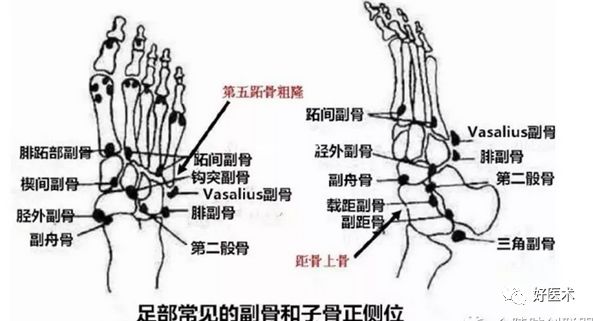 下面两张片子,如果不熟悉足部骨骼的正常变异,就很容易误诊为骨折.