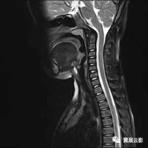 【病例】头颅ct示舌骨前下方异常密度,考虑哪种病变?