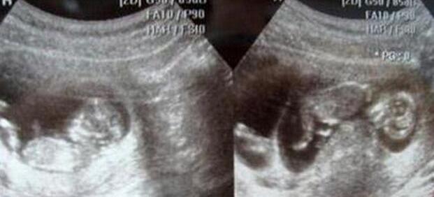 48岁女子孕检得知怀了龙凤胎,当孩子生出后,女子顿时