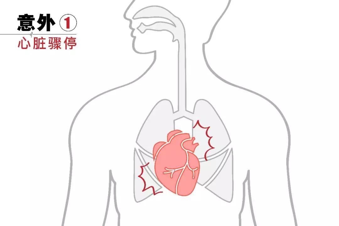 必须进行胸外按压和人工呼吸,争取进一步治疗的时间.