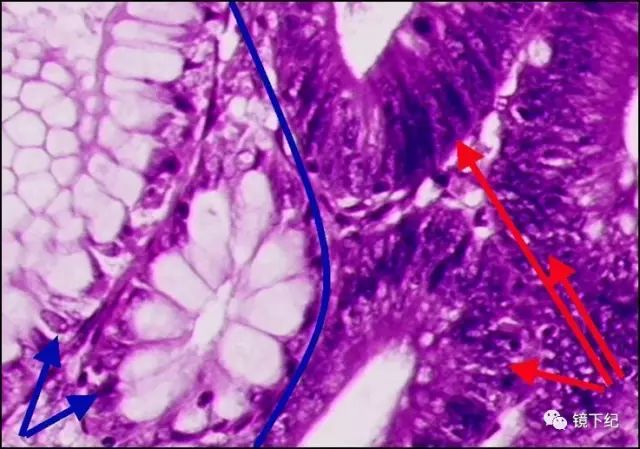 显微镜下看到左边(蓝箭头)是正常细胞,右边(红箭头)是癌细胞
