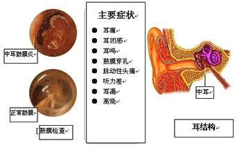 耳道出水流脓就是中耳炎吗