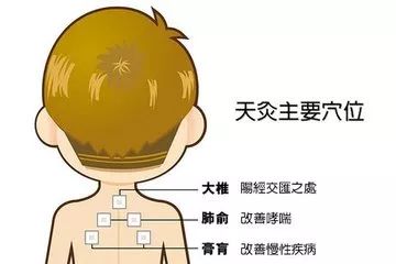 冬病夏治正当时,三伏贴什么人适合贴?什么人不适合贴?