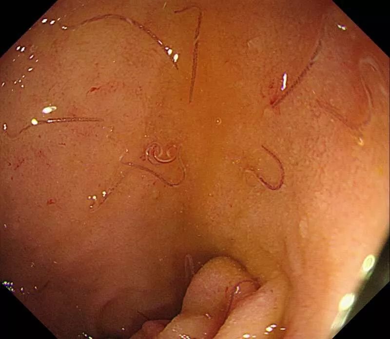 胃镜检查显示,蒋老太胃内有很多条可见的钩虫.