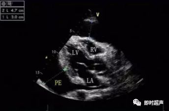 心包积液的超声诊断和测量方法