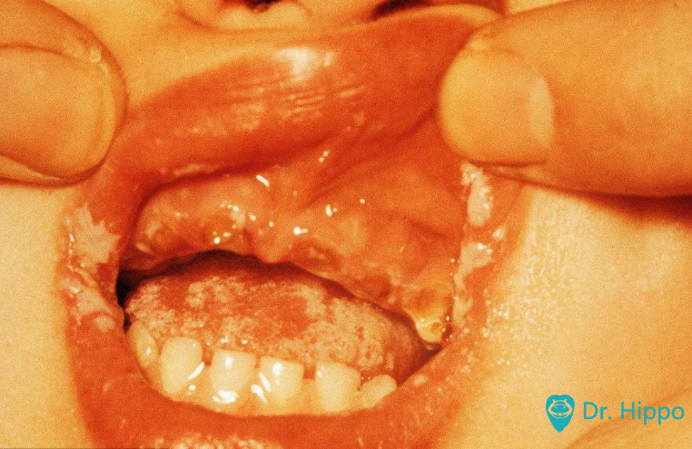 义齿性口炎是什么?