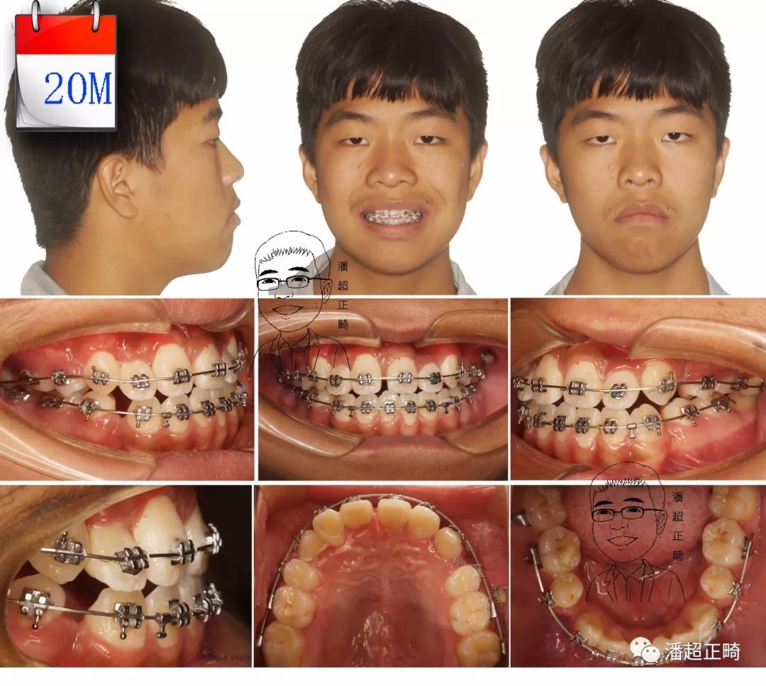 76期,4颗前牙埋伏阻生,反合生成趋势,青少年拔牙矫治一例