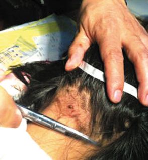 山东胶州的3岁孩子天天,被一只蜱虫钻到头皮里,家人及时送医手术才