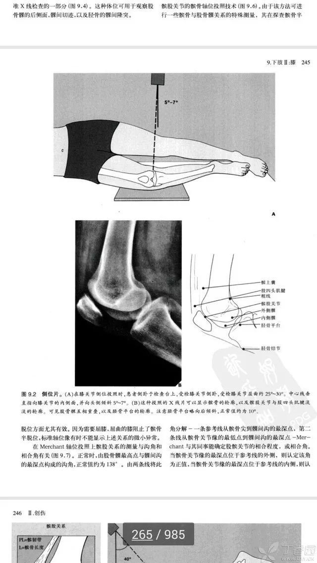 很典型的膝关节间接征象,难得一遇!