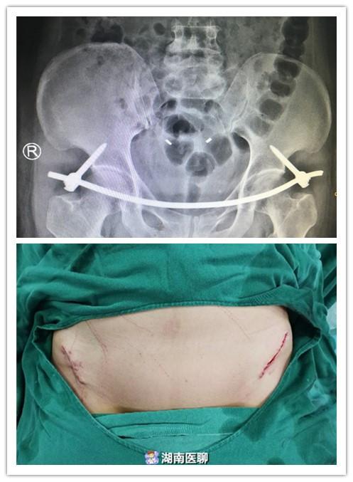 55岁女子车祸骨盆骨折手术后像没事人仅腰上两个小口子