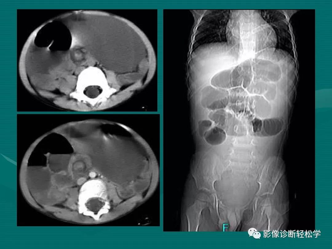 肠梗阻的影像诊断