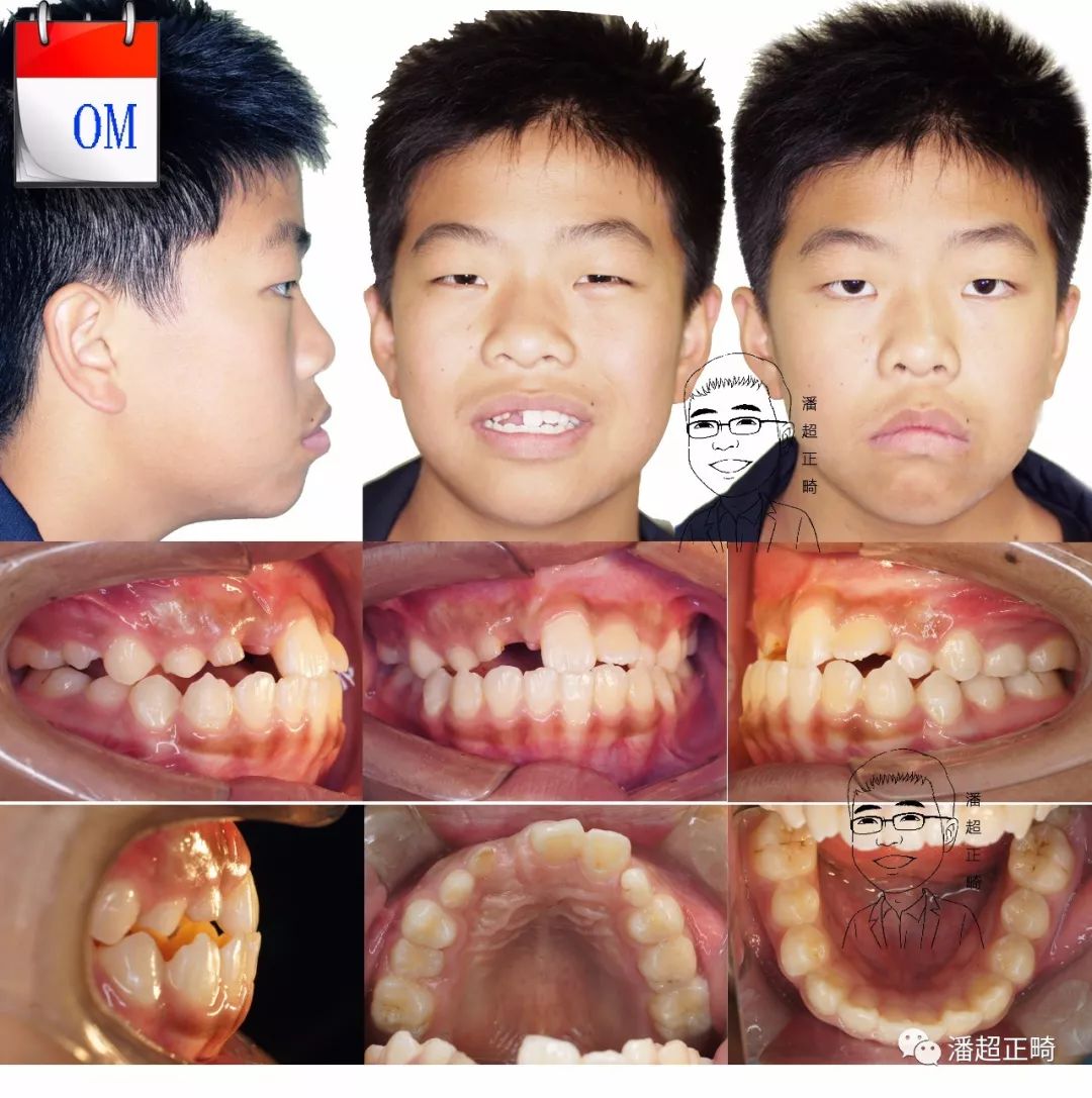 小孩轻微龅牙、个别牙反颌在成都圣贝口腔做正畸案例效果 - 成都圣贝口腔医院 - 开立特口腔