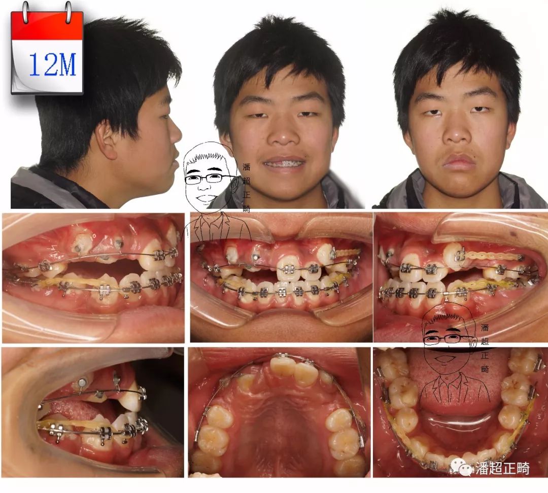 76期,4颗前牙埋伏阻生,反合生成趋势,青少年拔牙矫治一例