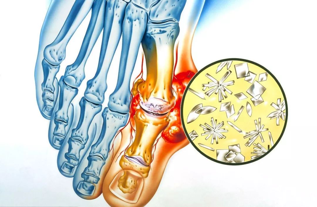比三高更可怕的是高尿酸每8人中就有1人患痛风最小才13岁牢记4句