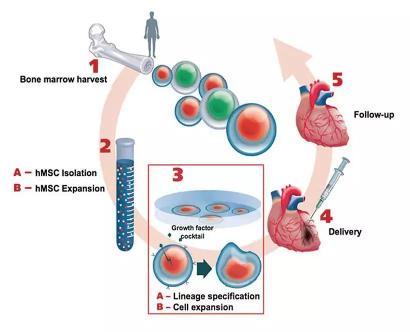 干细胞治疗心力衰竭示意图(cardio3science公司)