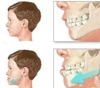 "地包天"是牙齿不整齐里非常复杂的一类,也是对孩子的容貌和身心健康