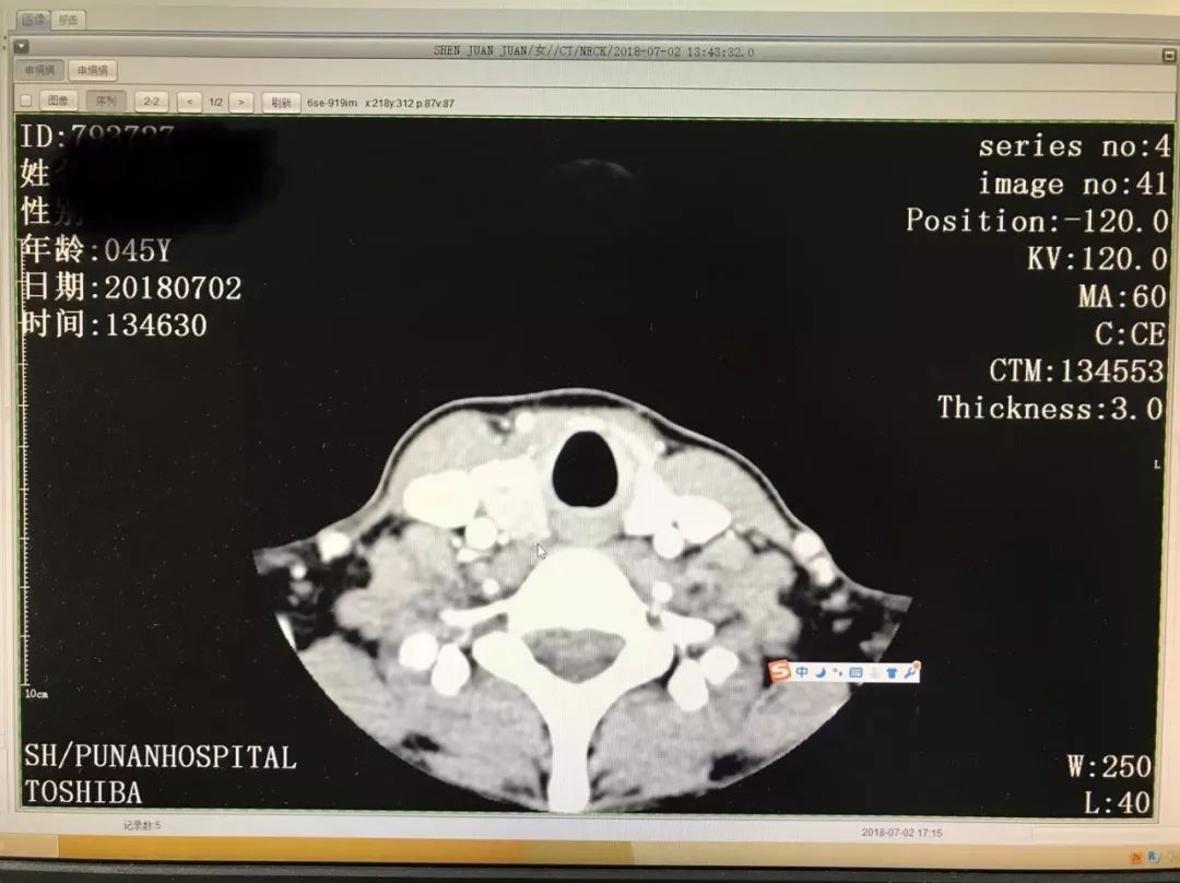 患者的ct图像:提示右甲状腺占位