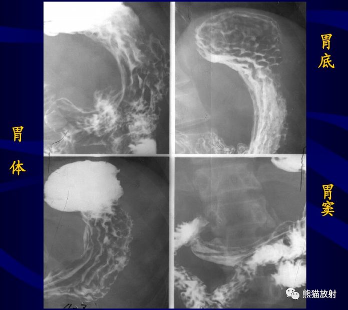 x线诊断要点丨慢性胃炎胃溃疡
