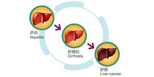 乙肝如何走向肝癌,需要多久转化为肝癌