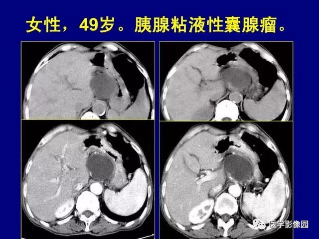 胰腺上皮样囊性肿瘤ct诊断分析 | 影像天地