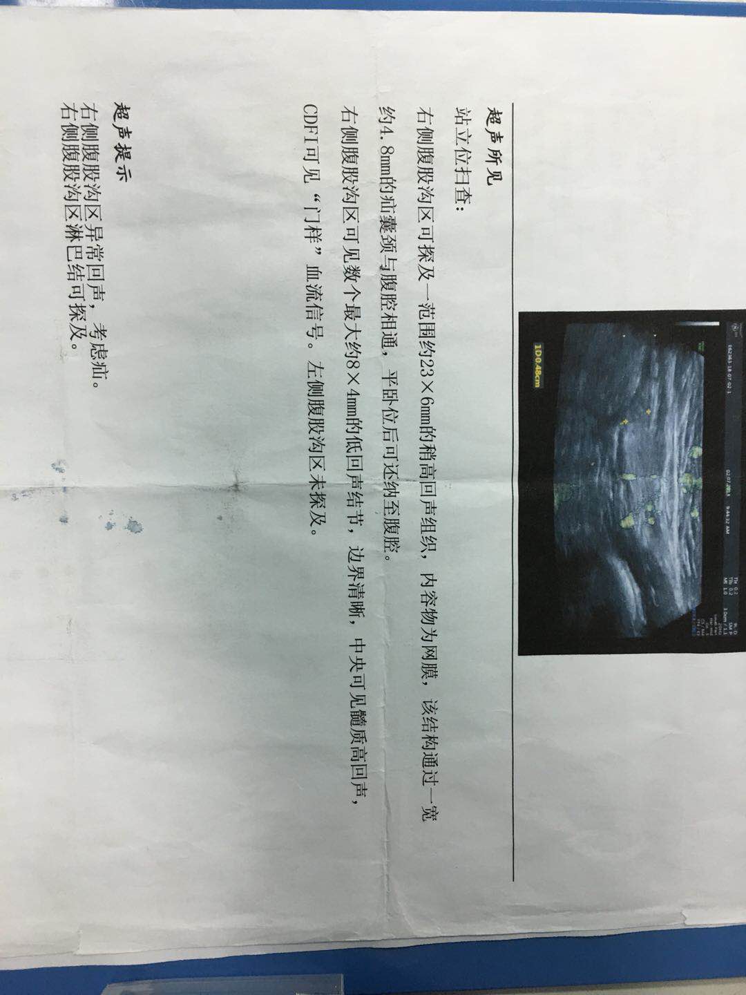 健康 正文  此患儿术前b超提示右侧腹股沟疝,曾在其他医院行硬化剂