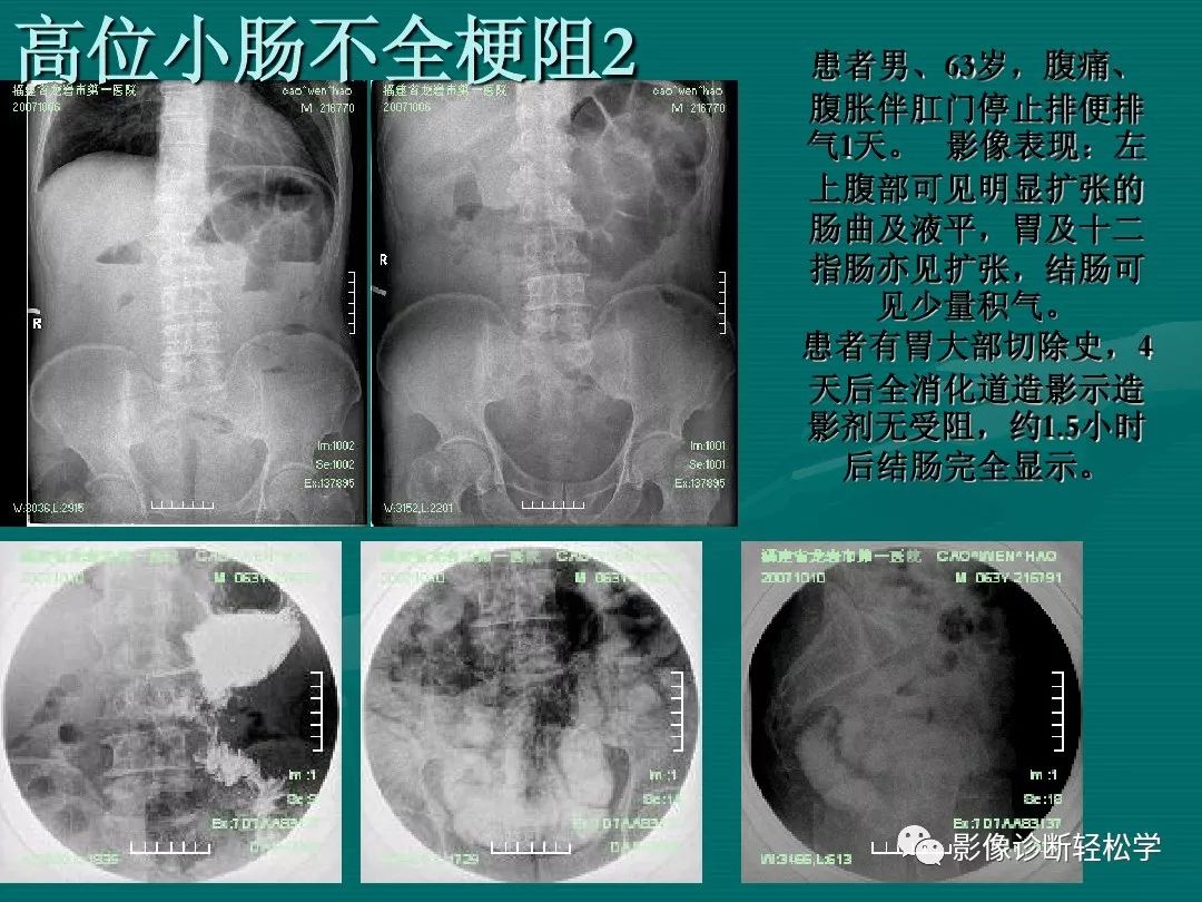 肠梗阻的影像诊断