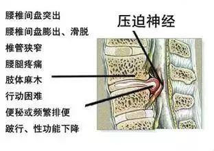 人体除了特定器官外 全部都受脊髓神经所支配 腰椎不好导致的疾病常