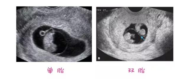 孕24周羊水偏少怎么办