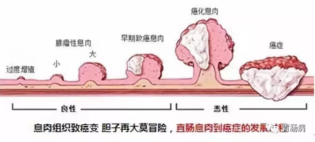 健康科普|我叫"息肉",很容易变成癌!